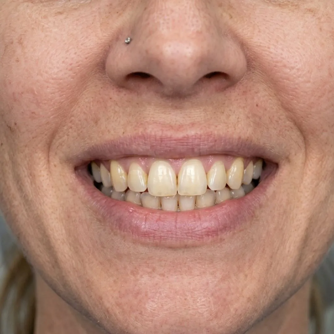 Sonrisa amarillenta antes del tratamiento estético dental