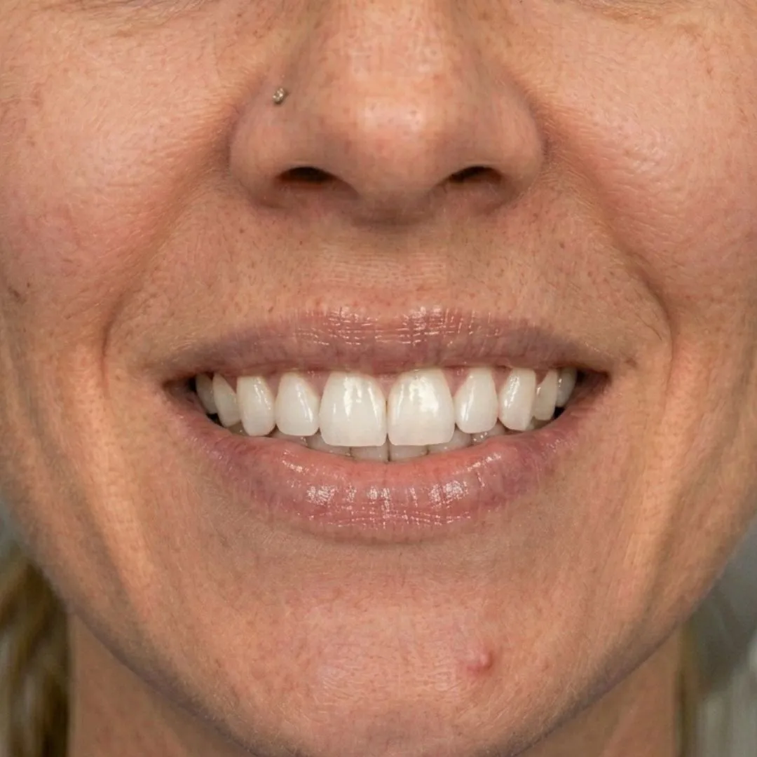Resultados finales después del tratamiento de blanqueamiento dental en Valdebebas