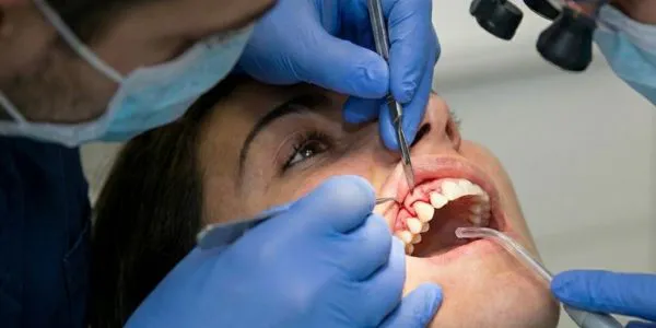 Alargamiento coronario avanzado para corregir sonrisa gingival en Madrid Norte