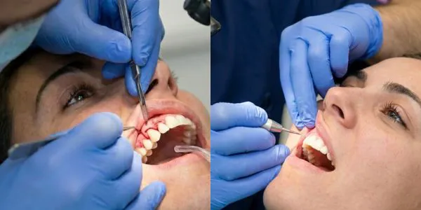 Tratamiento combinado de estética gingival y diseño de sonrisa en Valdebebas