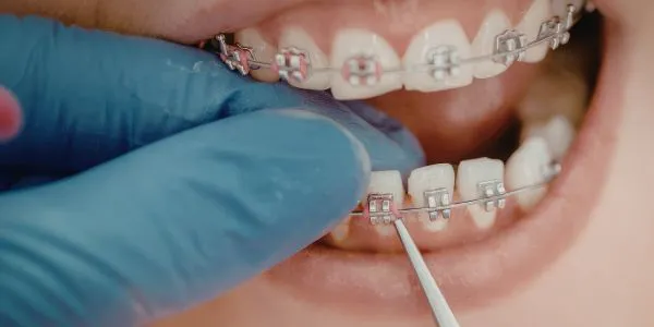 Brackets metálicos convencionales con ligaduras