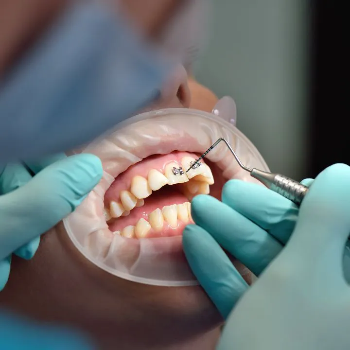 Brackets metálicos tradicionales en tratamiento de ortodoncia