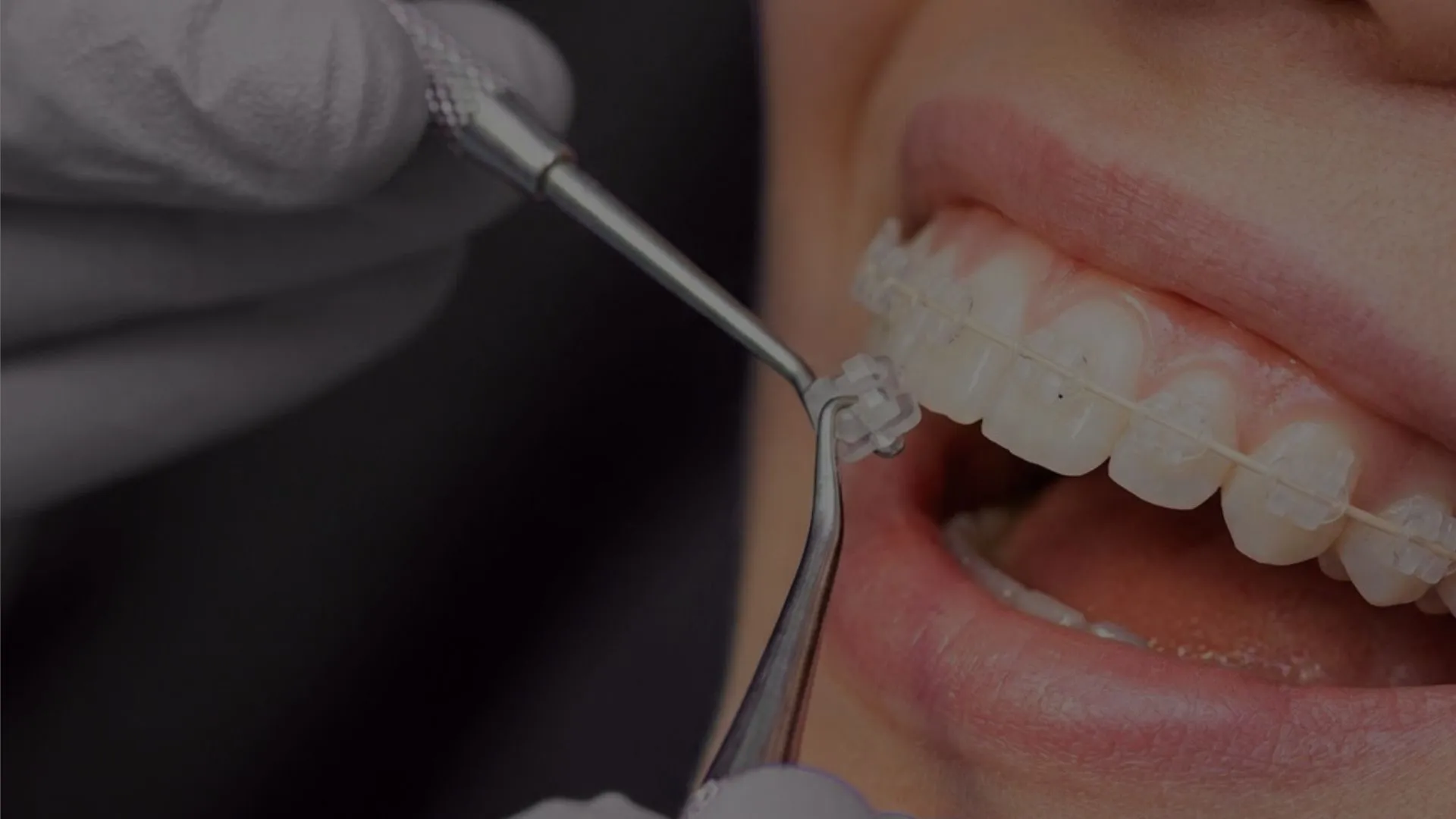 Brackets estéticos en Valdebebas y ortodoncia fija en Madrid Norte - Elevé Dental Group
