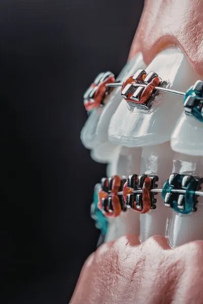 Brackets Metálicos Valdebebas
