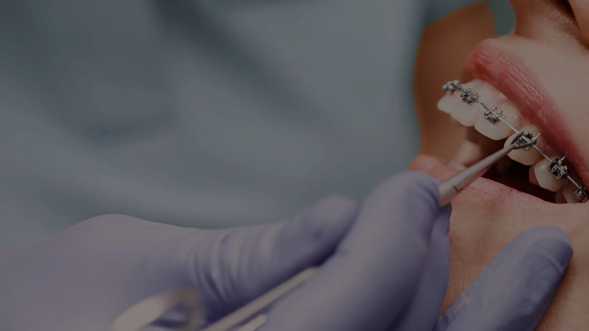 Brackets metálicos en Valdebebas y ortodoncia fija en Madrid Norte - Elevé Dental Group