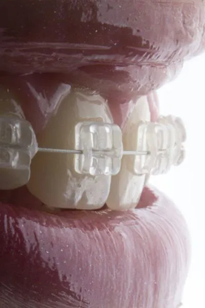 Brackets de Zafiro Valdebebas