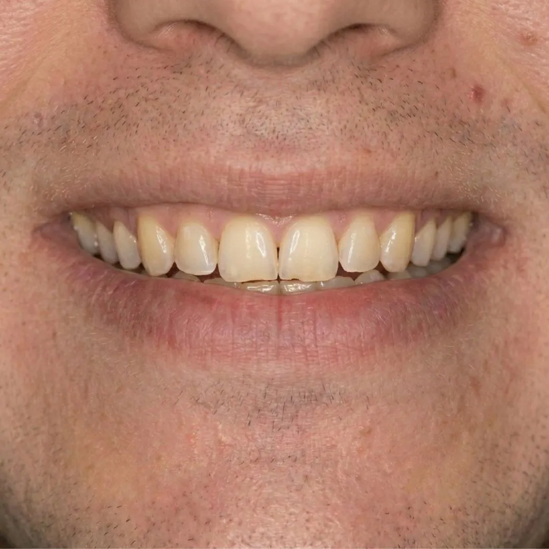 Dientes con desgaste y diastemas antes del tratamiento de carillas