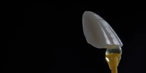 Aplicación artística de carillas de composite en Elevé Dental