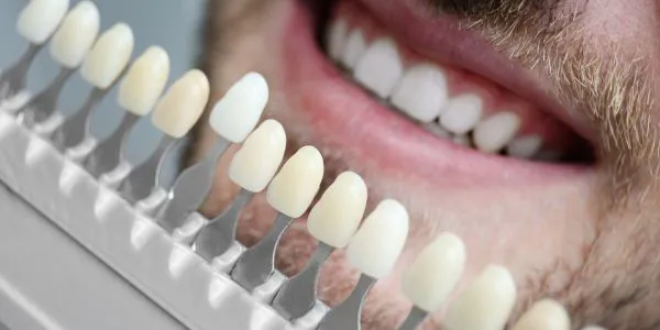Simulación digital de sonrisa para colocación de carillas dentales
