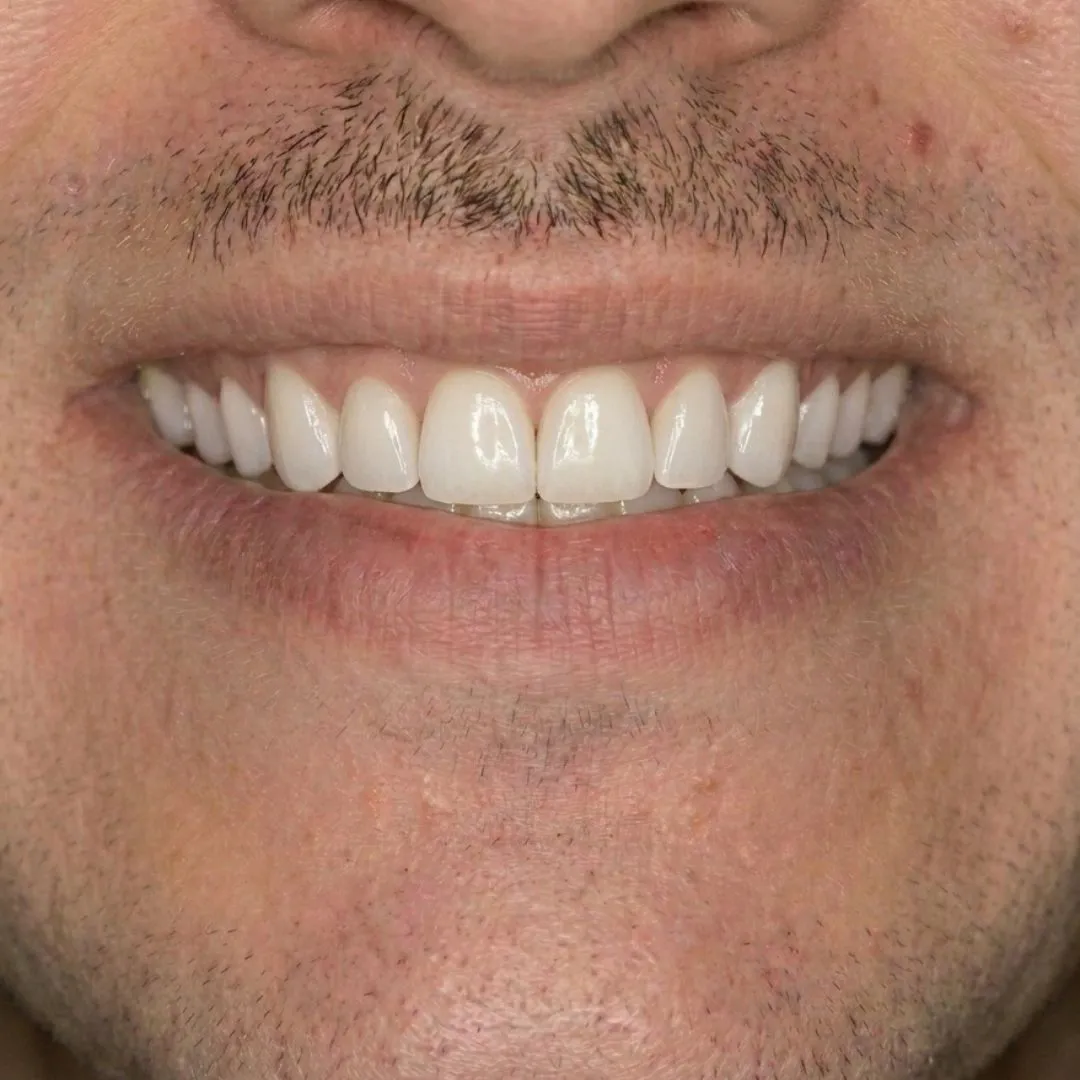 Sonrisa perfecta después de tratamiento con carillas de porcelana en Elevé Dental