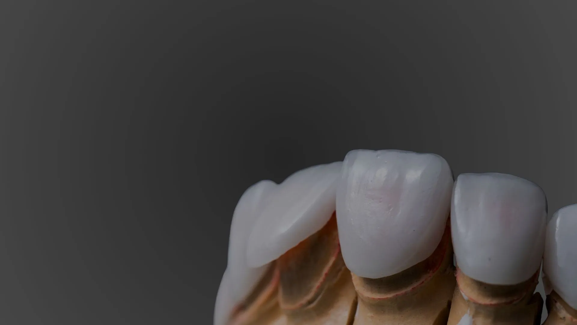 Carillas dentales en Valdebebas y diseño de sonrisa en Madrid Norte - Elevé Dental Group