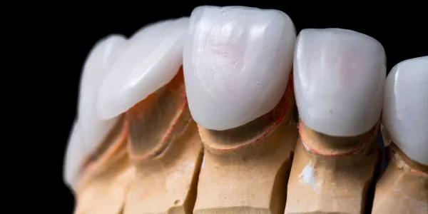 Carillas de porcelana ultrafinas de alta gama fabricadas en laboratorio