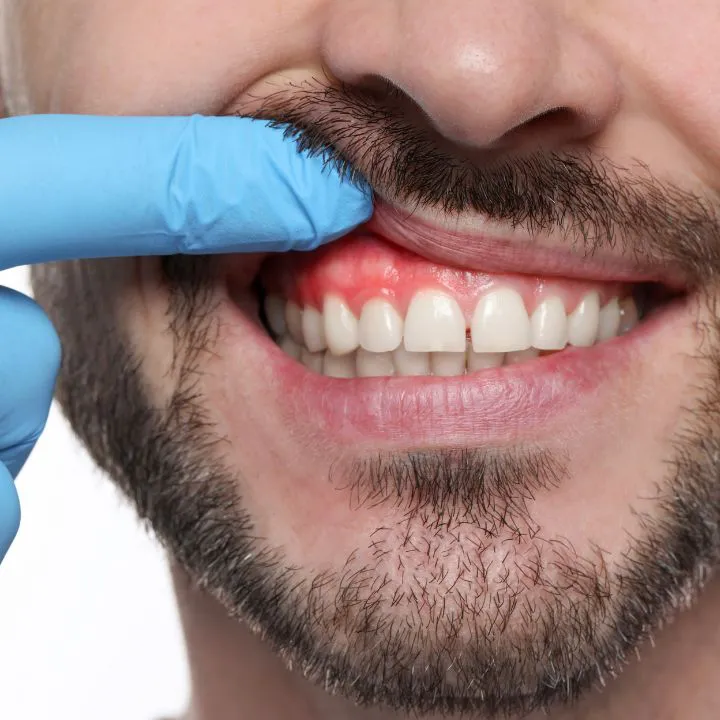 Simulación digital de sonrisa para colocación de carillas dentales