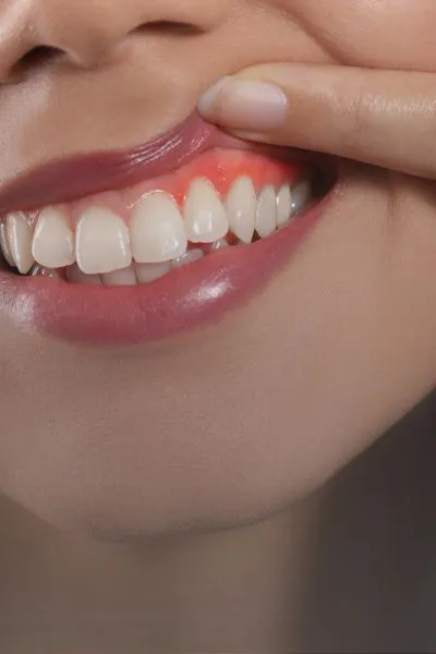 Contorneado Gingival