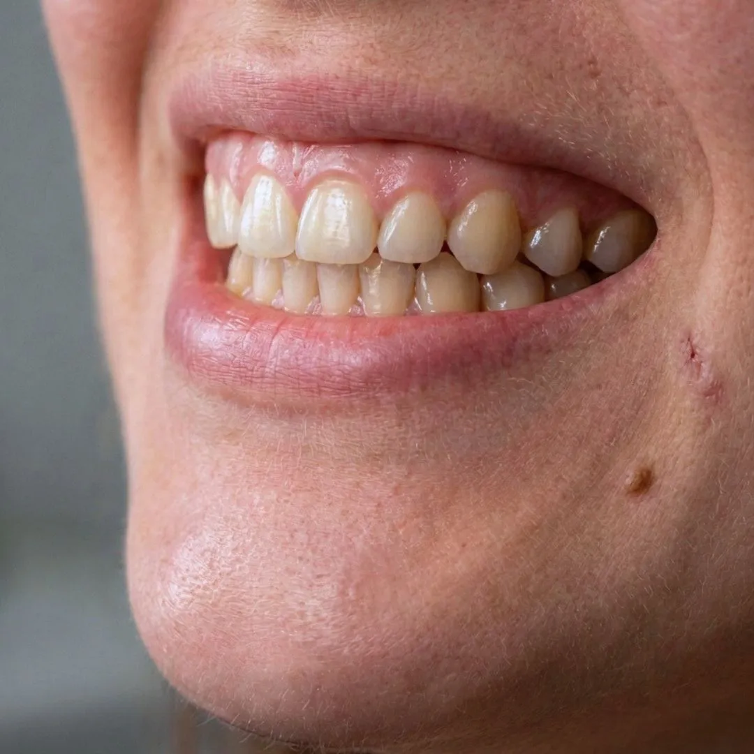 Sonrisa gingival antes del tratamiento de remodelación