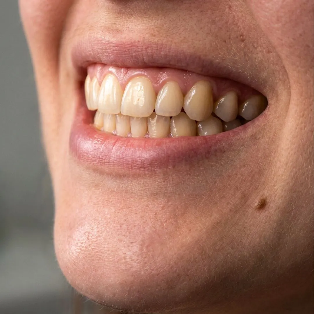 Sonrisa perfecta después de tratamiento de contorneado gingival
