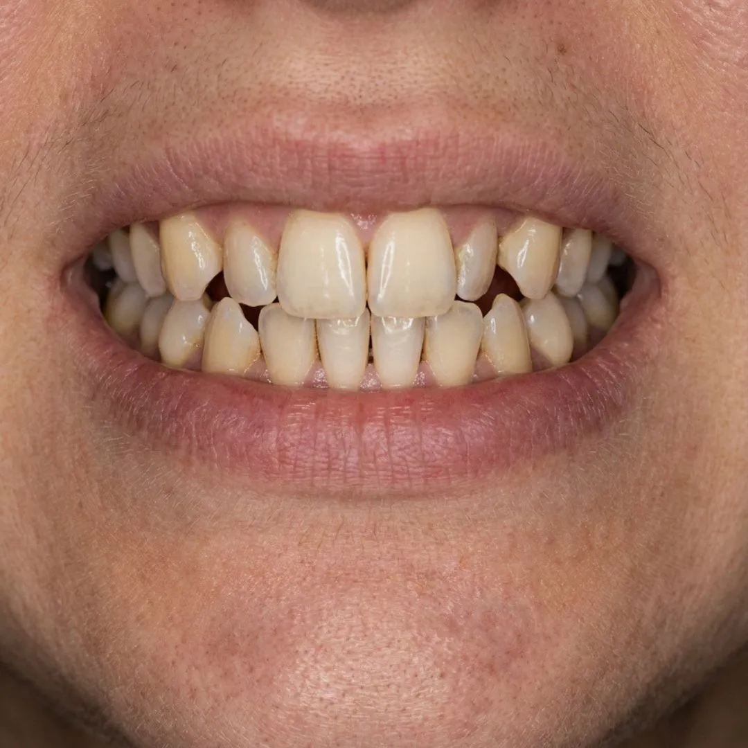 Apiñamiento dental antes del tratamiento