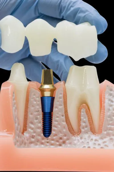 Puentes sobre Implantes Valdebebas
