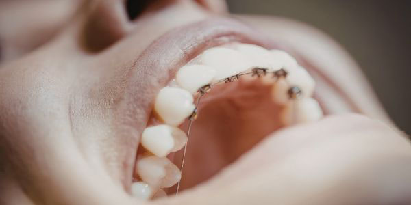 Brackets de autoligado sistema Damon