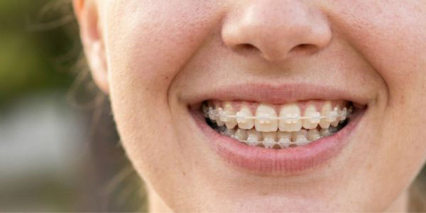 Brackets de zafiro monocristalinos transparentes