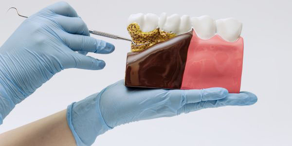 Curetaje periodontal en Valdebebas