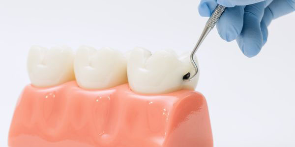 Limpieza dental con ultrasonidos en Valdebebas