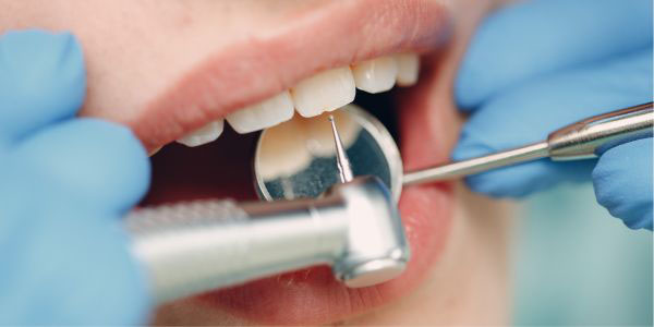 Profilaxis dental con aeropulidor en Madrid
