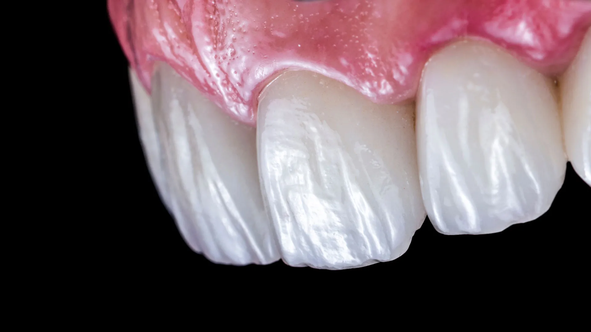 Primer plano de carillas dentales sin tallar ultrafinas, tratamiento avanzado de estética dental biomimética en Elevé Dental Group Valdebebas