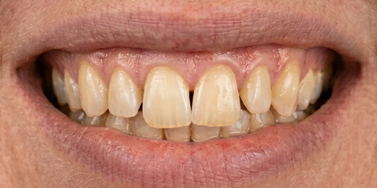 Estado inicial de la sonrisa de un paciente con desgaste en los dientes incisivos, antes de iniciar el tratamiento estético