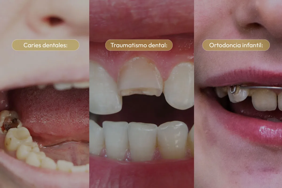 Tratamientos de odontopediatría en Madrid norte prevención de caries y ortodoncia interceptiva infantil